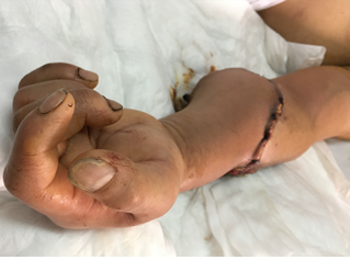 Bệnh viện Hữu nghị Việt Đức phẫu thuật vi phẫu “hồi sinh” 4 chi thể đứt rời trong 2 tuần cách ly xã hội